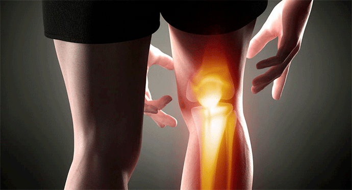 a térd artrózisának első jelei